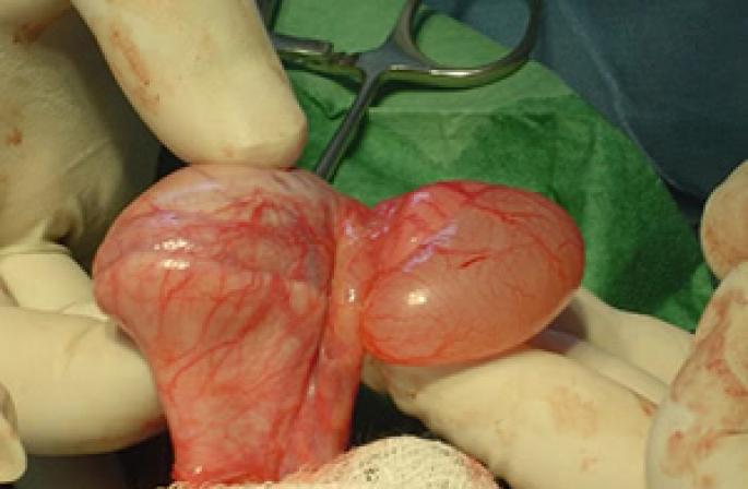 Операция по удалению кисты яичка у мужчины: как проходит и чего ожидать?